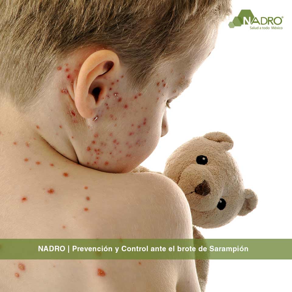NADRO | Prevención y Control ante el brote de Sarampión - Nadro